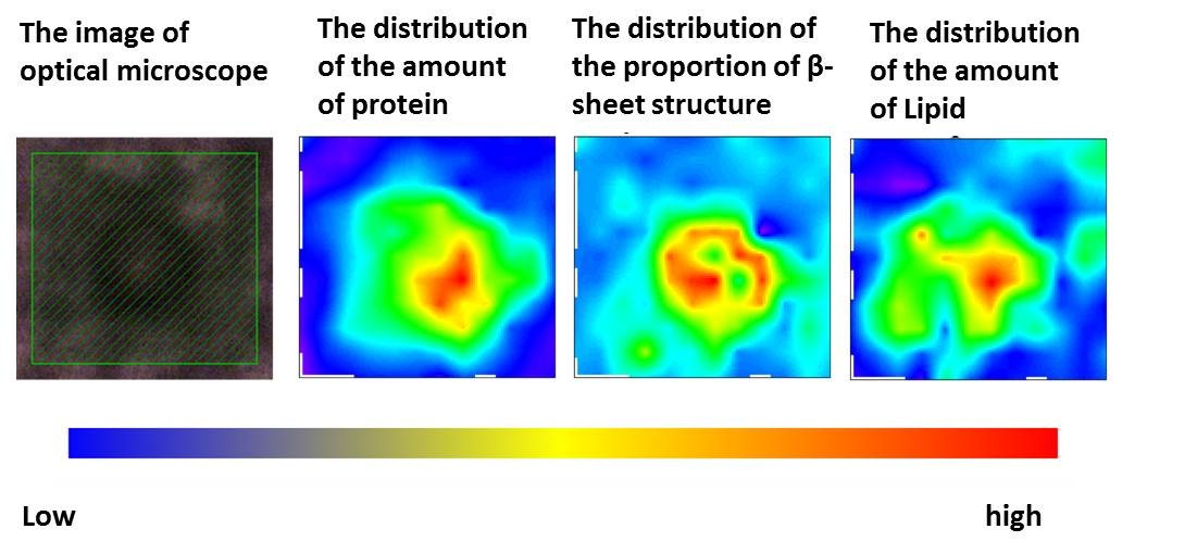 The analysis results for a typical Lewy bodies